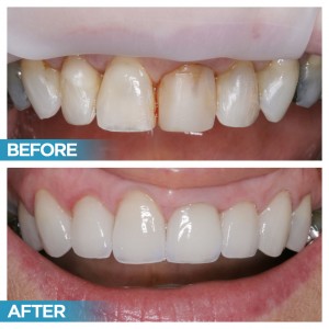 Dental Implants (Before & After)