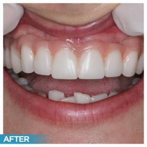 Dental Implants (Before & After)